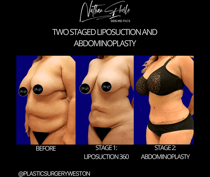 Tummy Tuck before and after case 16, actual patient at Weston Center for Plastic Surgery