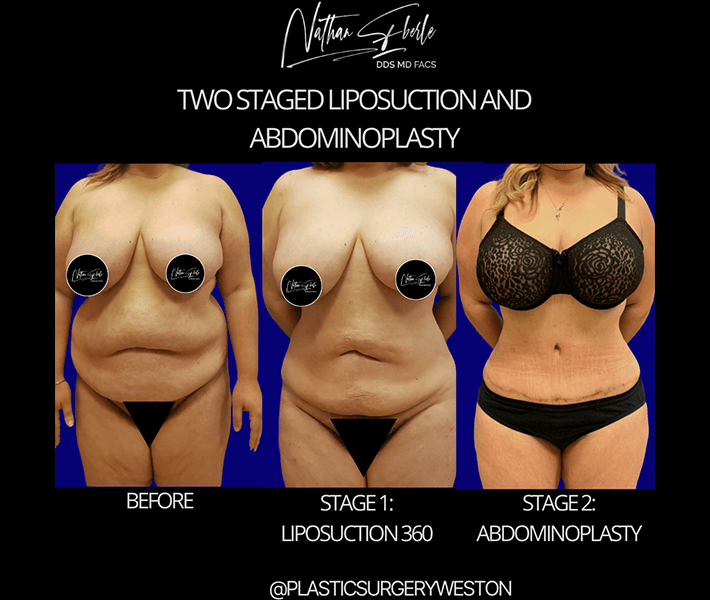 Tummy Tuck before and after case 17, actual patient at Weston Center for Plastic Surgery