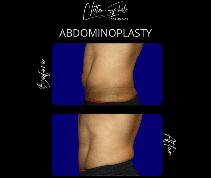 Tummy Tuck before and after case 18, actual patient at Weston Center for Plastic Surgery