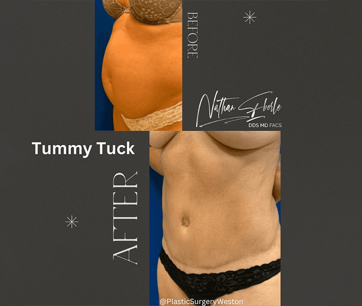 Tummy Tuck before and after case 19, actual patient at Weston Center for Plastic Surgery