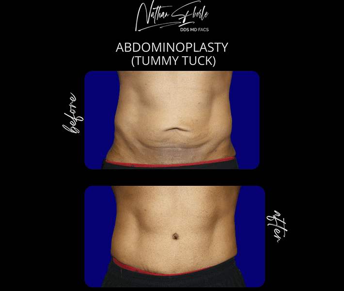 Tummy Tuck before and after case 2, actual patient at Weston Center for Plastic Surgery