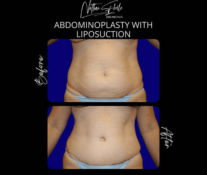 Tummy Tuck before and after case 20, actual patient at Weston Center for Plastic Surgery