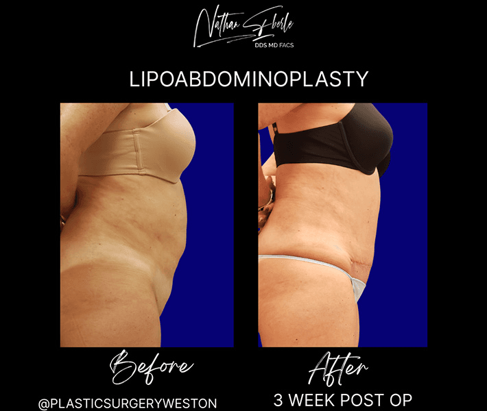 Tummy Tuck before and after case 21, actual patient at Weston Center for Plastic Surgery