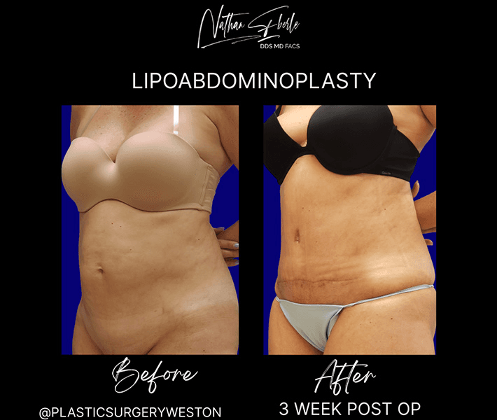 Tummy Tuck before and after case 23, actual patient at Weston Center for Plastic Surgery