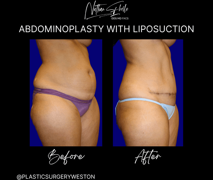 Tummy Tuck before and after case 24, actual patient at Weston Center for Plastic Surgery