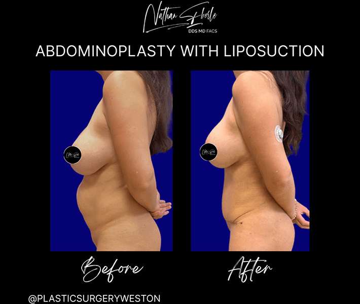 Tummy Tuck before and after case 25, actual patient at Weston Center for Plastic Surgery