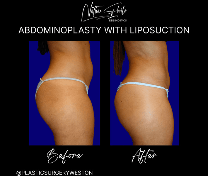 Tummy Tuck before and after case 26, actual patient at Weston Center for Plastic Surgery
