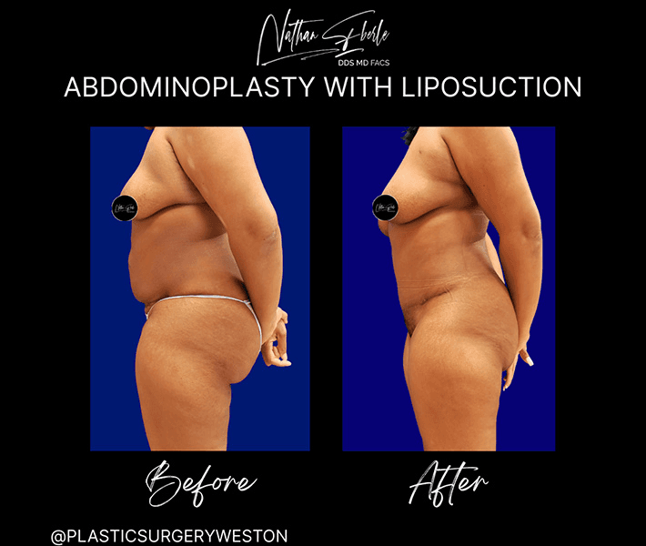 Tummy Tuck before and after case 27, actual patient at Weston Center for Plastic Surgery