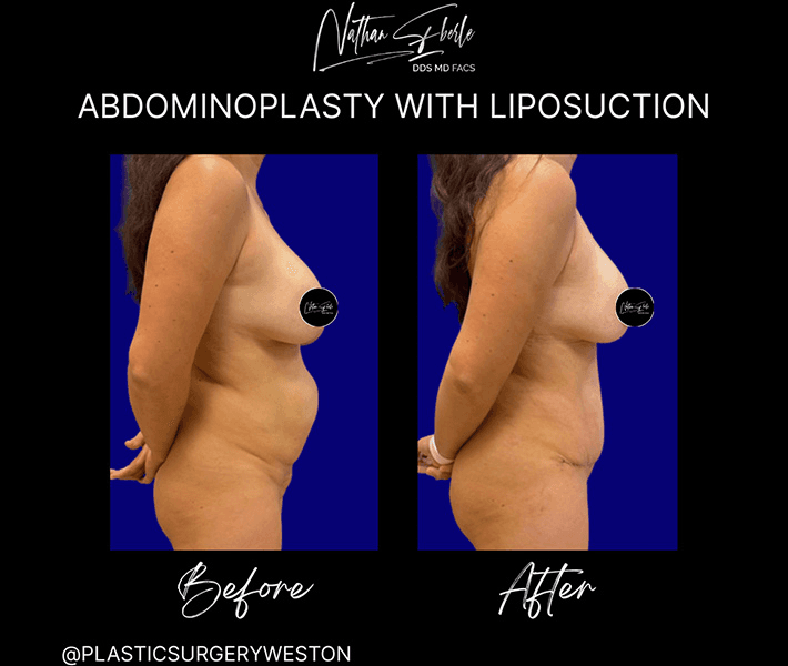 Tummy Tuck before and after case 28, actual patient at Weston Center for Plastic Surgery