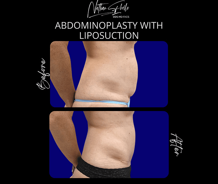 Tummy Tuck before and after case 29, actual patient at Weston Center for Plastic Surgery