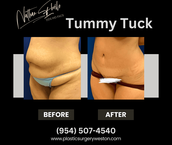 Tummy Tuck before and after case 3, actual patient at Weston Center for Plastic Surgery
