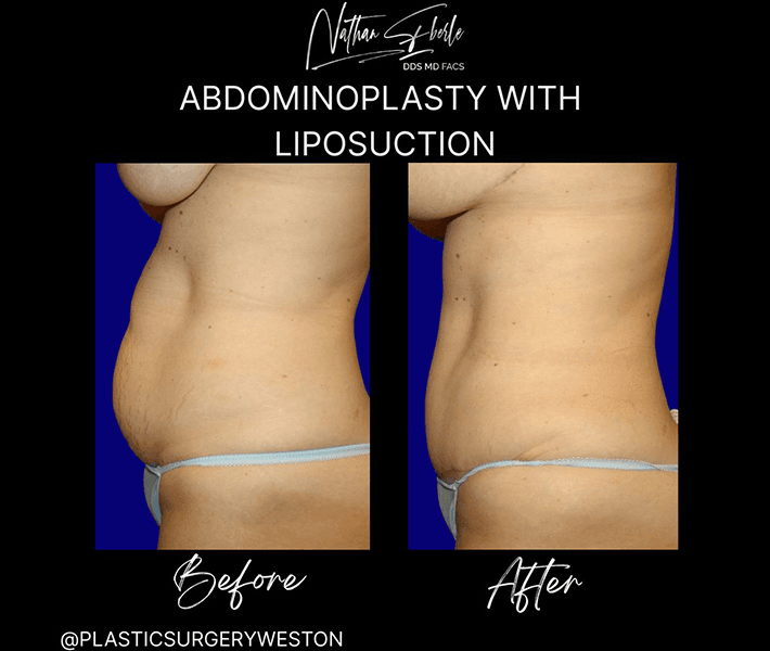 Tummy Tuck before and after case 30, actual patient at Weston Center for Plastic Surgery
