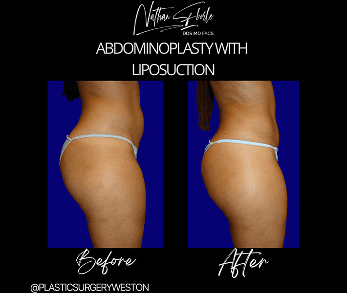 Tummy Tuck before and after case 31, actual patient at Weston Center for Plastic Surgery