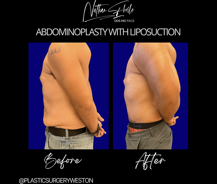 Tummy Tuck before and after case 33, actual patient at Weston Center for Plastic Surgery