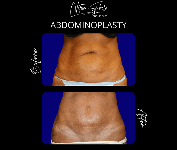 Tummy Tuck before and after case 4, actual patient at Weston Center for Plastic Surgery