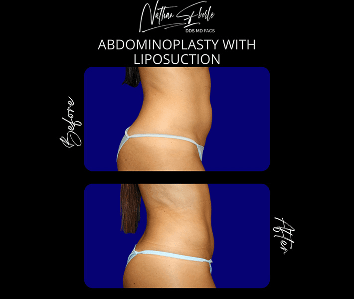 Tummy Tuck before and after case 40, actual patient at Weston Center for Plastic Surgery