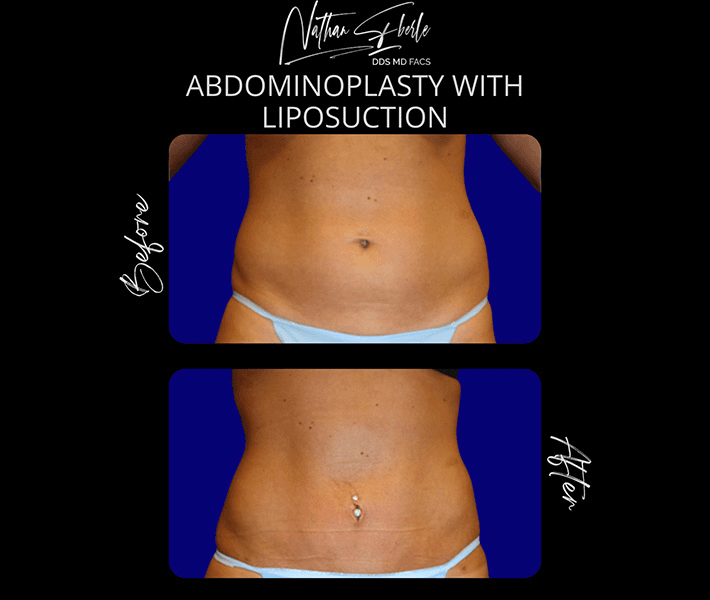 Tummy Tuck before and after case 42, actual patient at Weston Center for Plastic Surgery