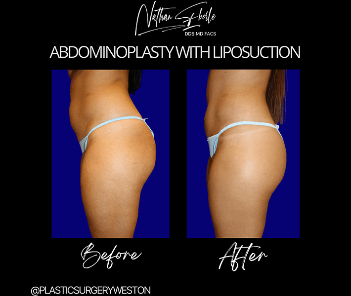 Tummy Tuck before and after case 43, actual patient at Weston Center for Plastic Surgery