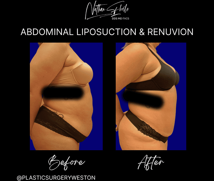 Tummy Tuck before and after case 44, actual patient at Weston Center for Plastic Surgery