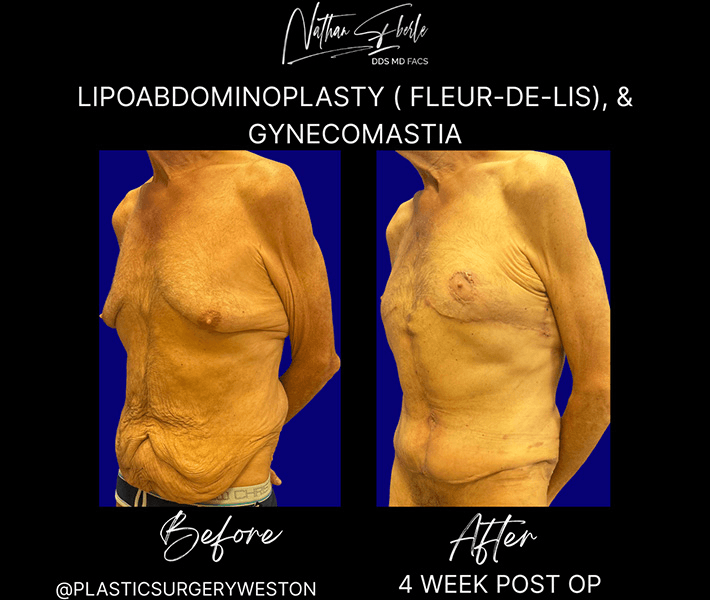 Tummy Tuck before and after case 45, actual patient at Weston Center for Plastic Surgery