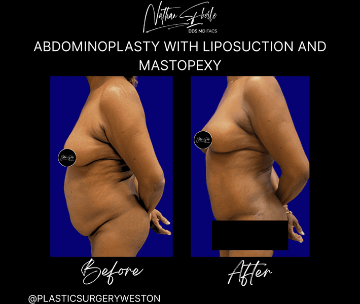 Tummy Tuck before and after case 46, actual patient at Weston Center for Plastic Surgery