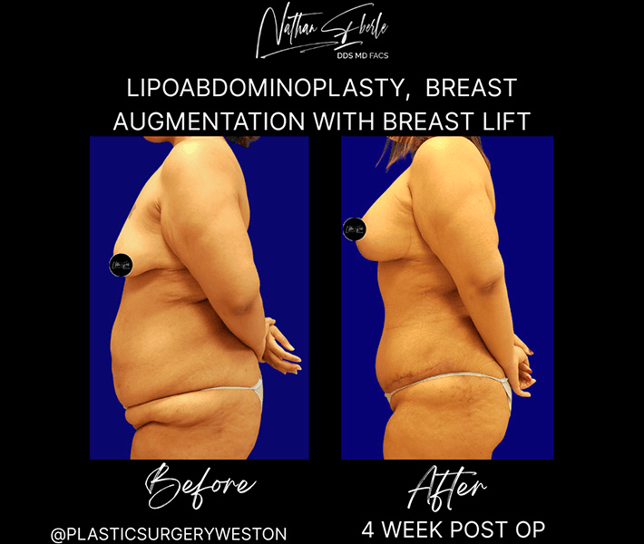 Tummy Tuck before and after case 48, actual patient at Weston Center for Plastic Surgery