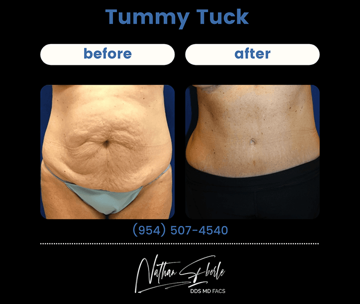 Tummy Tuck before and after case 5, actual patient at Weston Center for Plastic Surgery