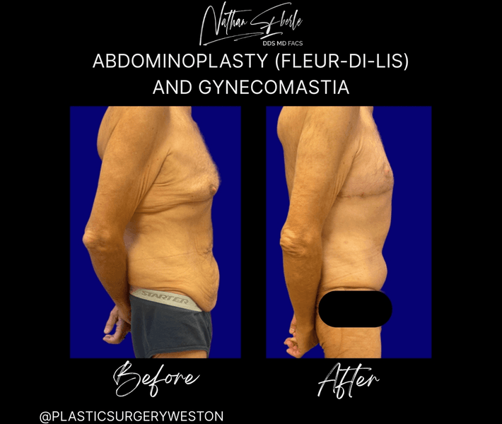 Tummy Tuck before and after case 51, actual patient at Weston Center for Plastic Surgery