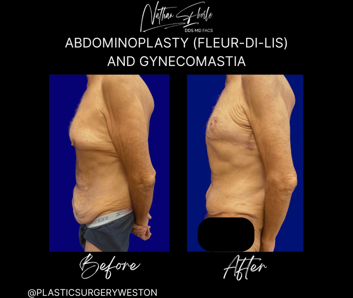 Tummy Tuck before and after case 52, actual patient at Weston Center for Plastic Surgery