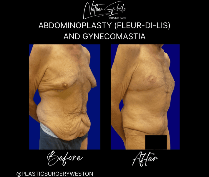 Tummy Tuck before and after case 53, actual patient at Weston Center for Plastic Surgery
