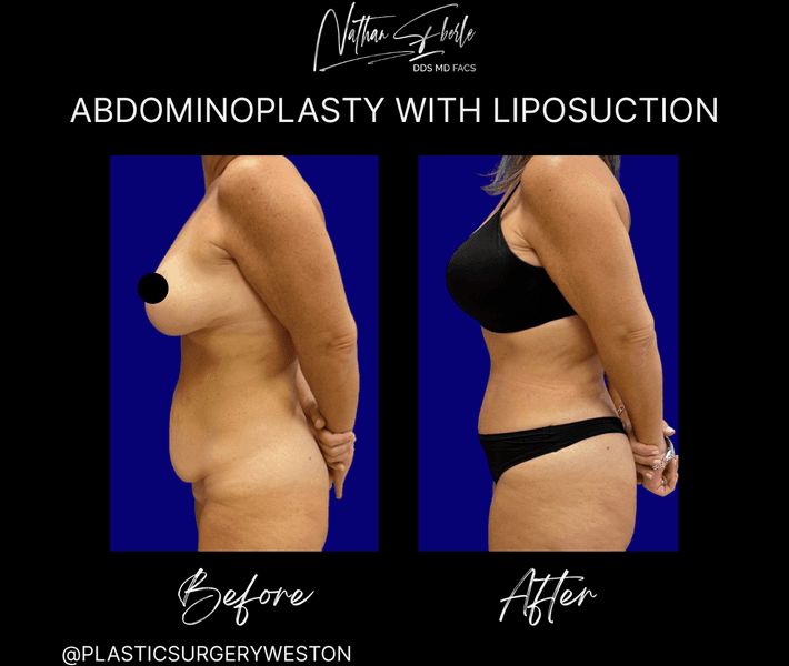 Tummy Tuck before and after case 54, actual patient at Weston Center for Plastic Surgery