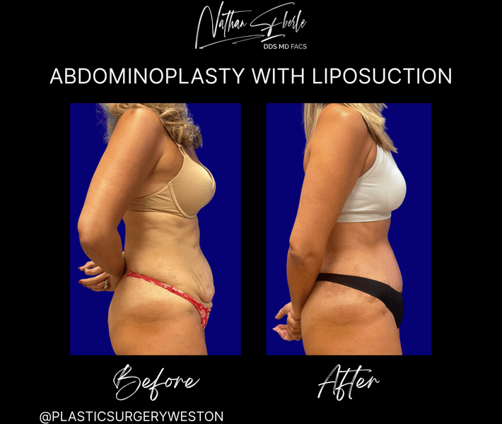 Tummy Tuck before and after case 55, actual patient at Weston Center for Plastic Surgery