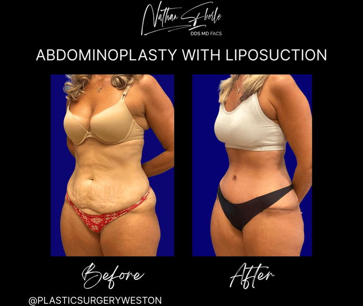 Tummy Tuck before and after case 56, actual patient at Weston Center for Plastic Surgery