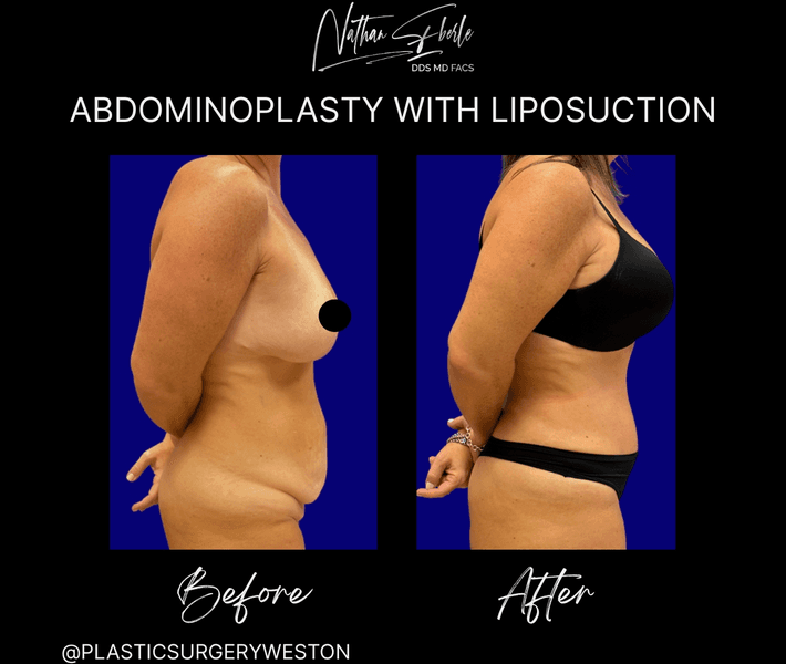 Tummy Tuck before and after case 57, actual patient at Weston Center for Plastic Surgery