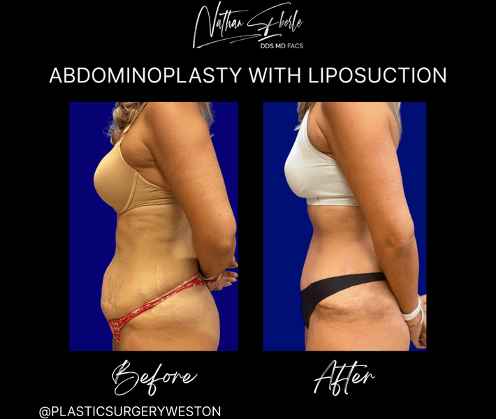 Tummy Tuck before and after case 58, actual patient at Weston Center for Plastic Surgery