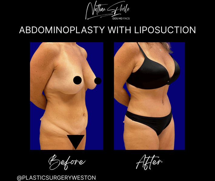 Tummy Tuck before and after case 59, actual patient at Weston Center for Plastic Surgery