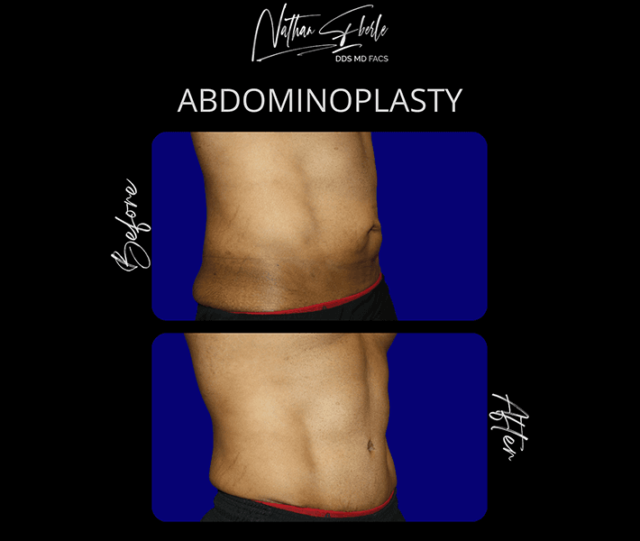 Tummy Tuck before and after case 6, actual patient at Weston Center for Plastic Surgery