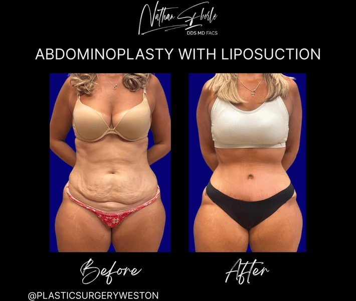 Tummy Tuck before and after case 60, actual patient at Weston Center for Plastic Surgery