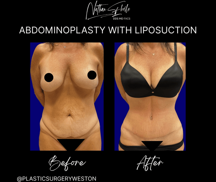 Tummy Tuck before and after case 61, actual patient at Weston Center for Plastic Surgery