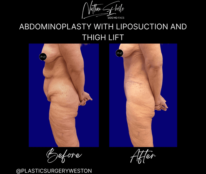 Tummy Tuck before and after case 62, actual patient at Weston Center for Plastic Surgery