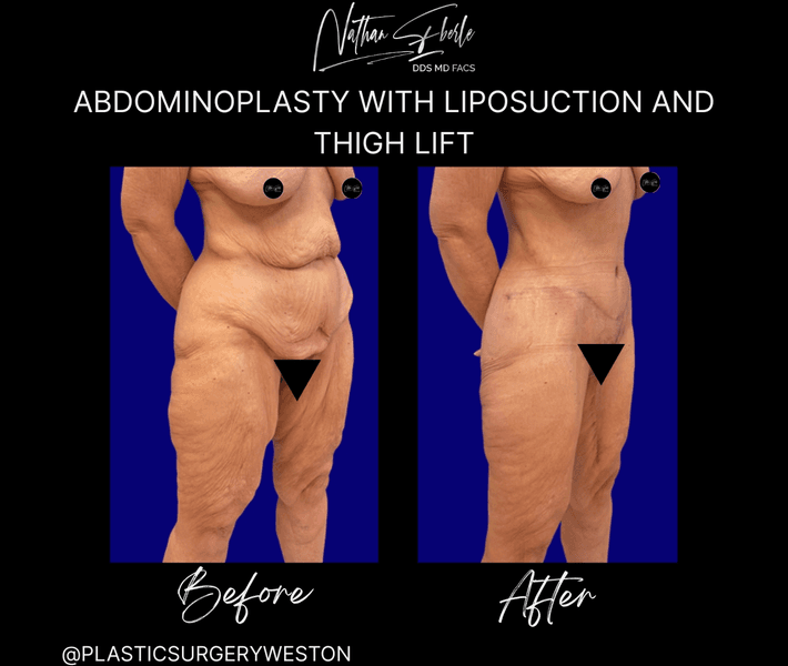 Tummy Tuck before and after case 63, actual patient at Weston Center for Plastic Surgery