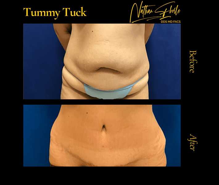 Tummy Tuck before and after case 7, actual patient at Weston Center for Plastic Surgery