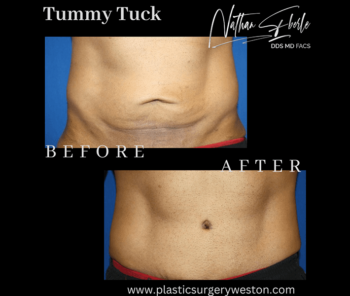 Tummy Tuck before and after case 9, actual patient at Weston Center for Plastic Surgery