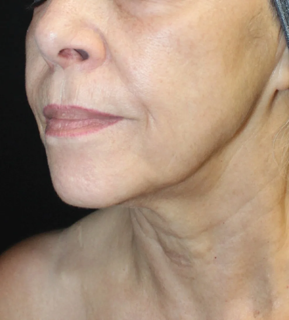UltraClear laser after photo — texture & firmness at Weston Center for Plastic Surgery