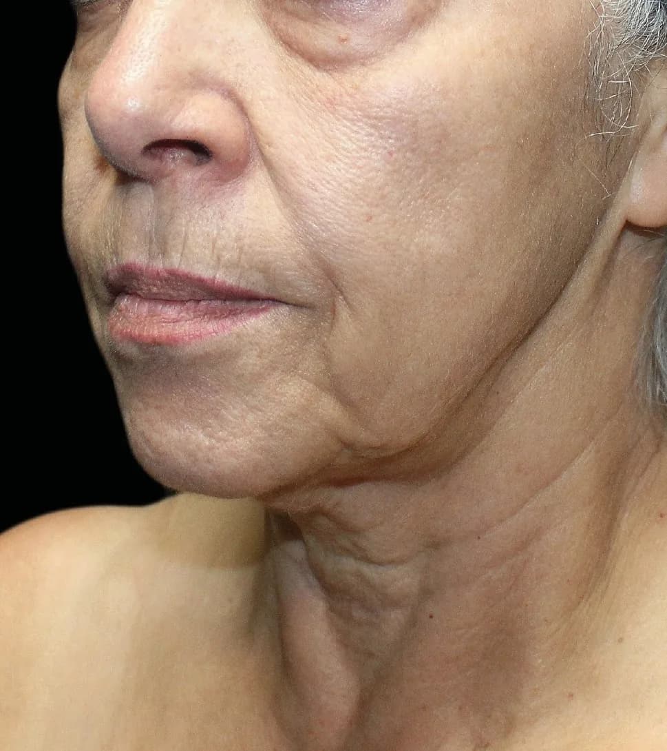UltraClear laser before photo — texture & firmness at Weston Center for Plastic Surgery