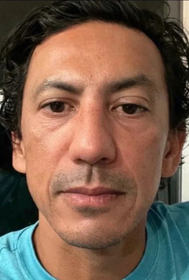 UltraClear laser after photo — brightness & even tone at Weston Center for Plastic Surgery