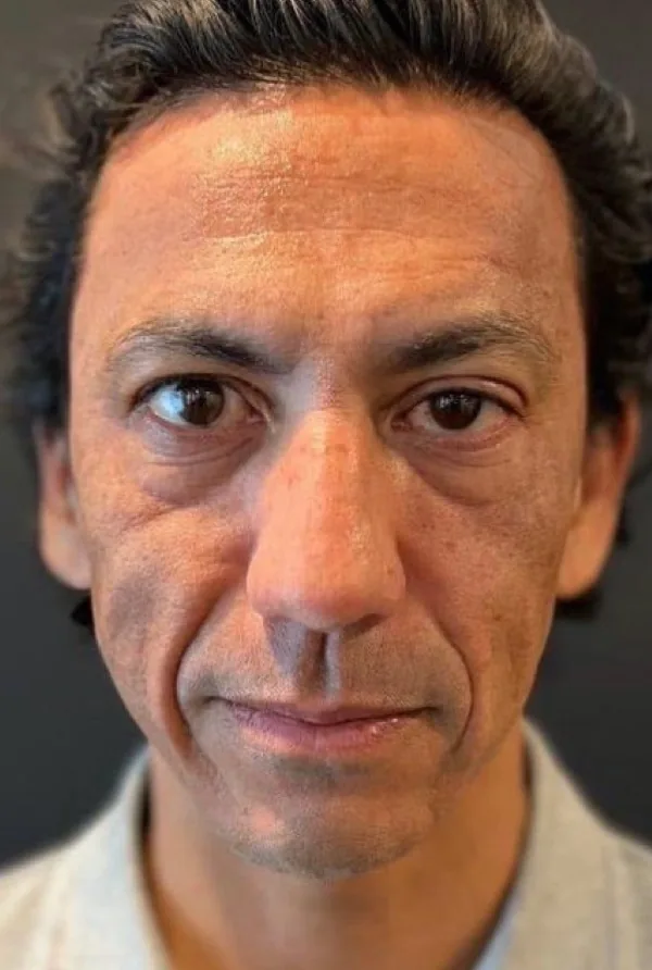 UltraClear laser before photo — brightness & even tone at Weston Center for Plastic Surgery