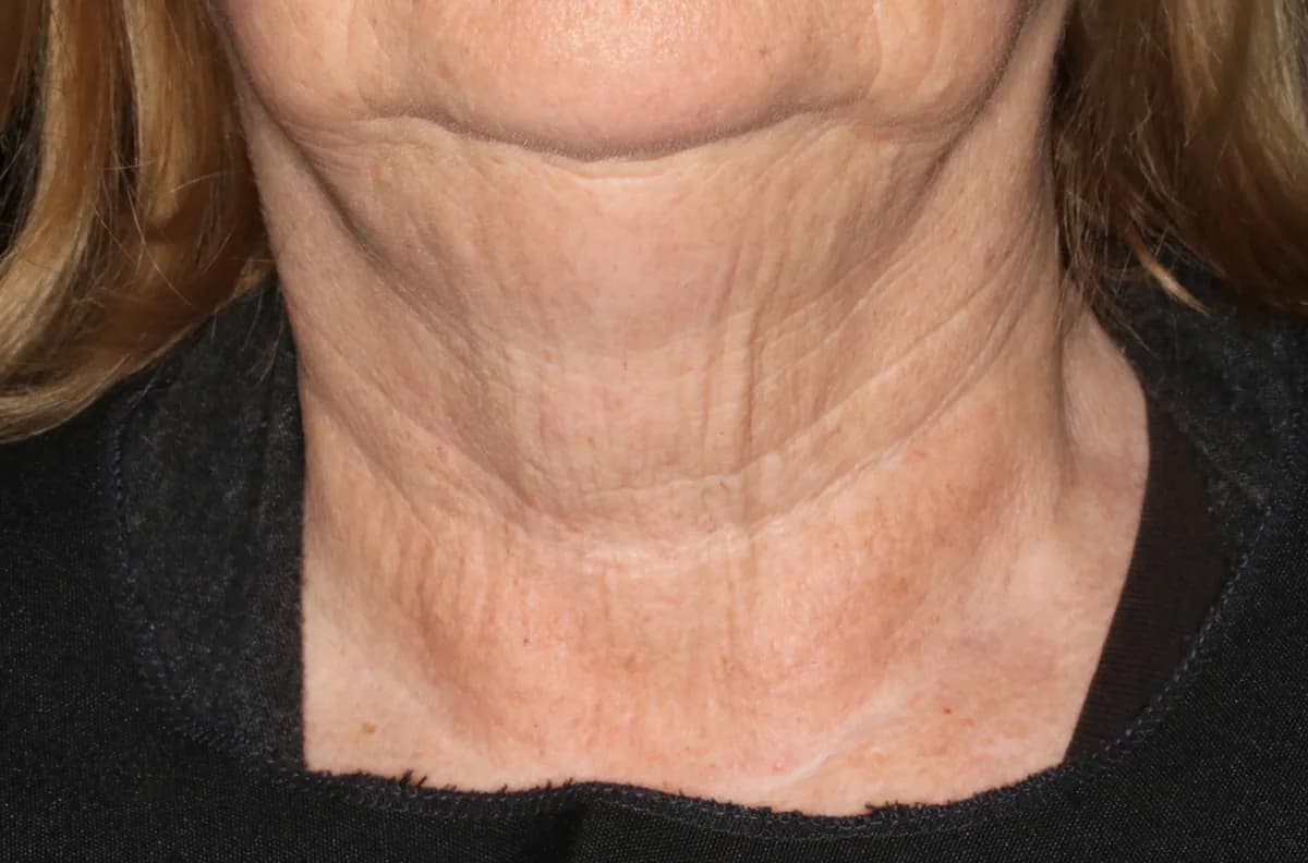 UltraClear laser after photo — neck laxity & crepey skin at Weston Center for Plastic Surgery
