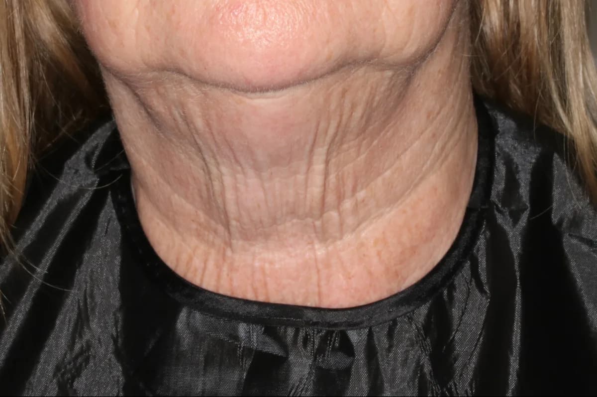 UltraClear laser before photo — neck laxity & crepey skin at Weston Center for Plastic Surgery