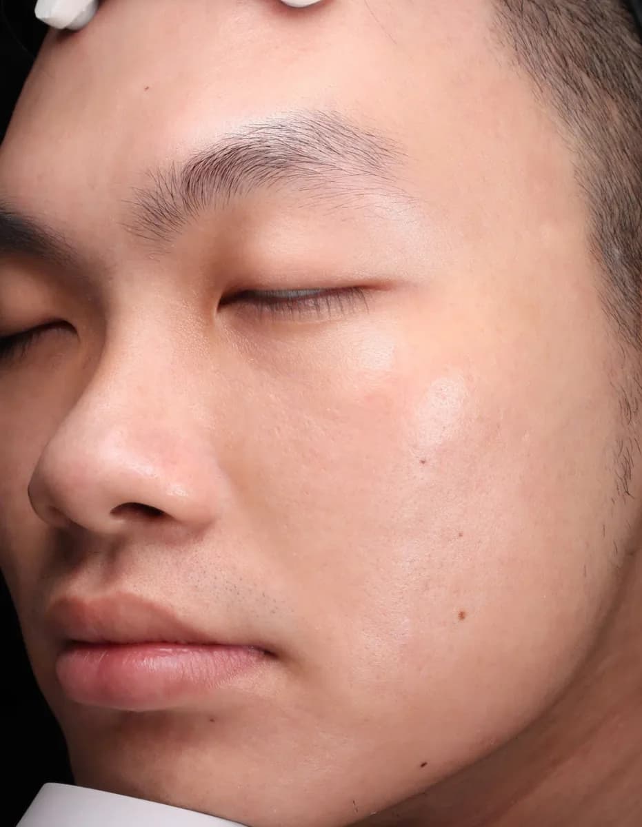 UltraClear laser after photo — pigmentation & melasma at Weston Center for Plastic Surgery